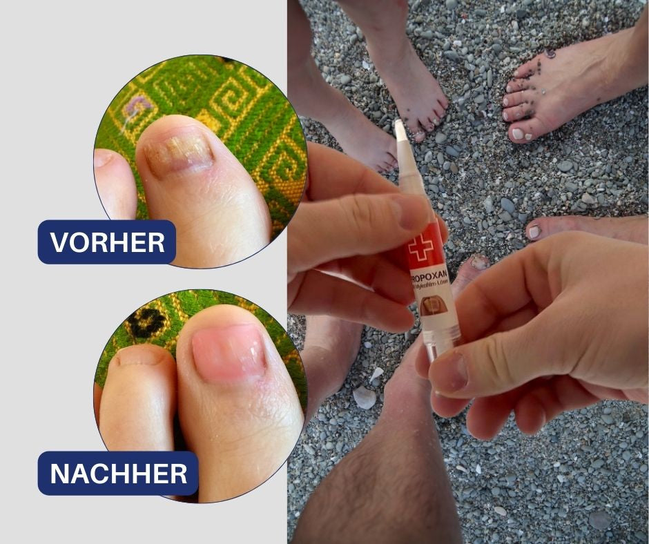 Propoxan_Gesunde Nagelstruktur in_3_Monaten